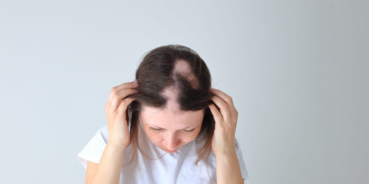 AbbVie Reports Positive Phase 3 Results for Alopecia Areata Drug