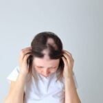 AbbVie Reports Positive Phase 3 Results for Alopecia Areata Drug