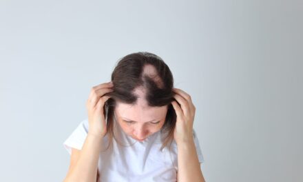 AbbVie Reports Positive Phase 3 Results for Alopecia Areata Drug