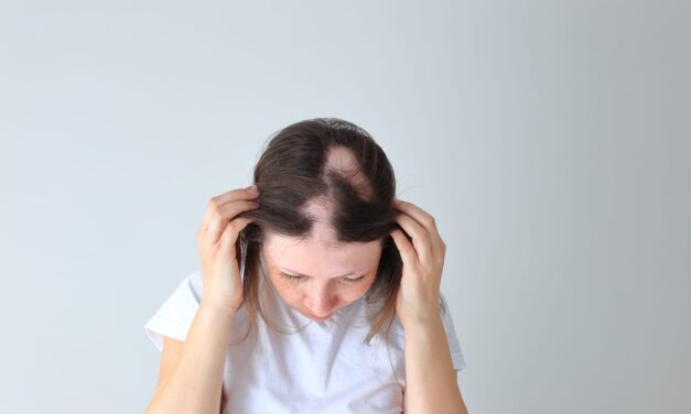 AbbVie Reports Positive Phase 3 Results for Alopecia Areata Drug
