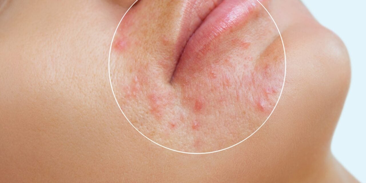 New Residency Program to Offer Training on Acne Laser Technology