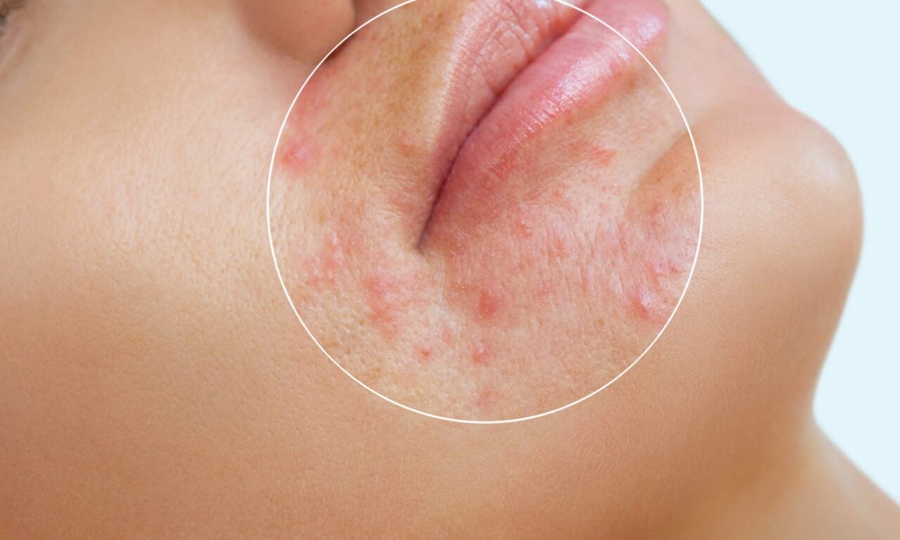 New Residency Program to Offer Training on Acne Laser Technology