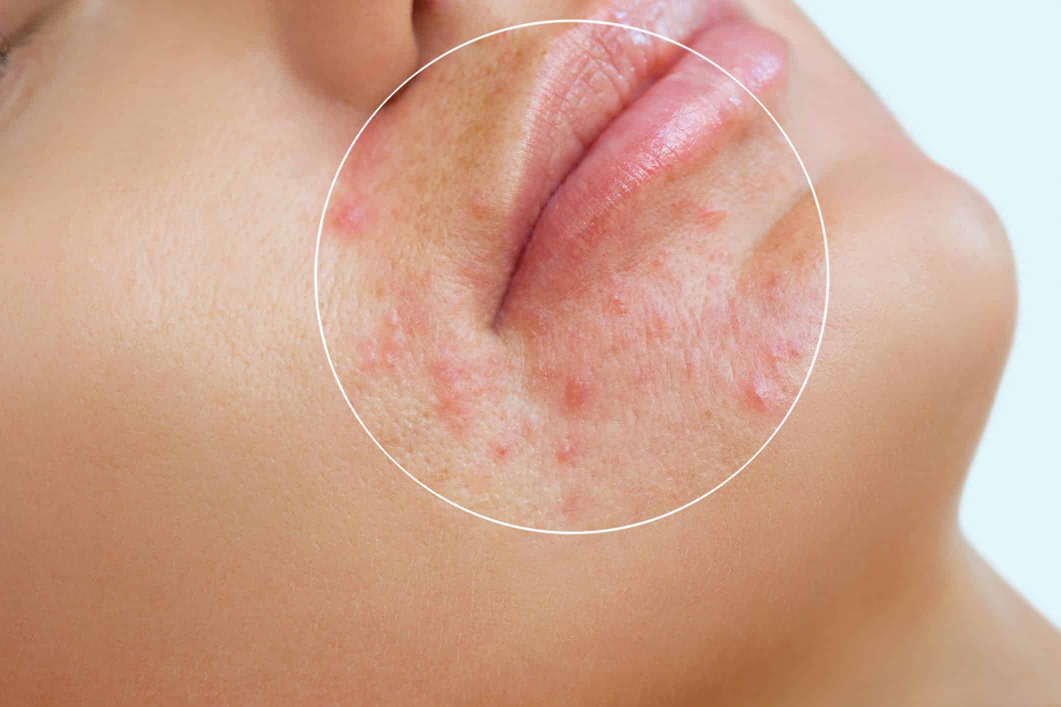New Residency Program to Offer Training on Acne Laser Technology ...