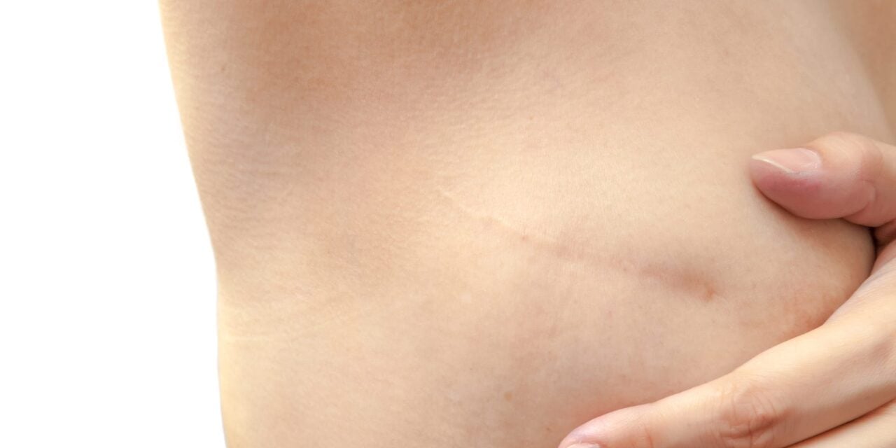 Proposed Bill Aims to Strengthen Insurance Protections for Breast Reconstruction