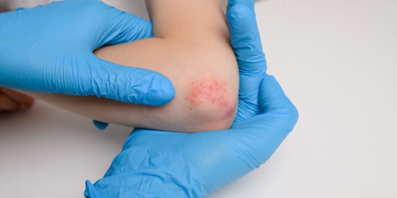 FDA Approves IL-23 Inhibitor for Pediatric Psoriasis and Psoriatic Arthritis