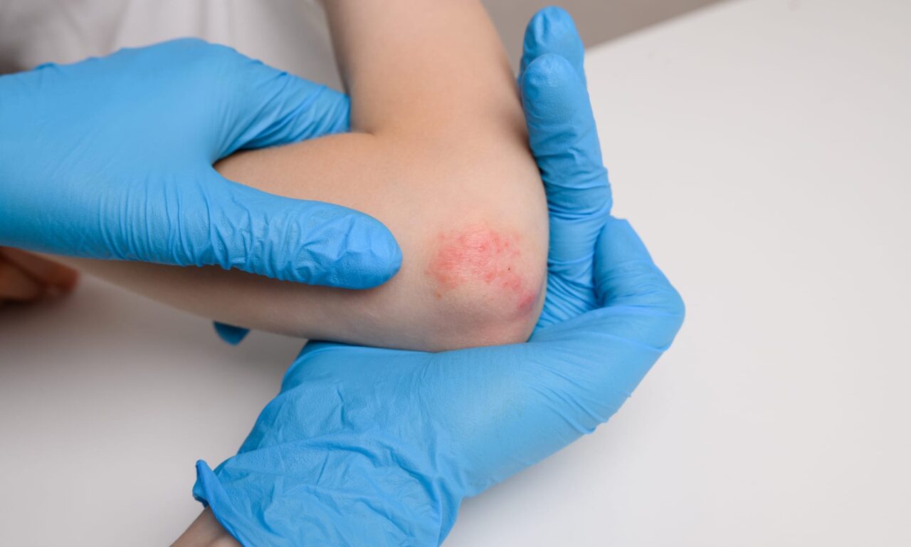 FDA Approves IL-23 Inhibitor for Pediatric Psoriasis and Psoriatic Arthritis