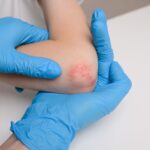 FDA Approves IL-23 Inhibitor for Pediatric Psoriasis and Psoriatic Arthritis