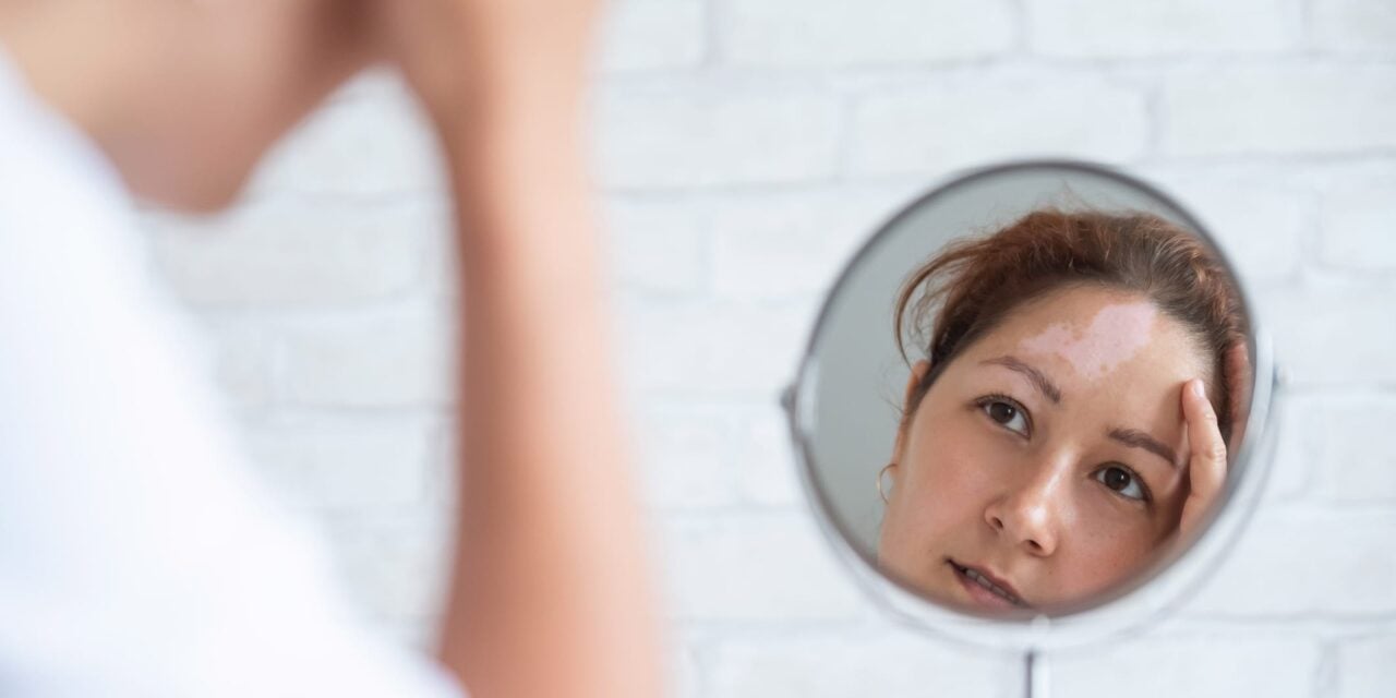 Study Finds Excimer Laser, JAK Inhibitor Combo Effective for Vitiligo