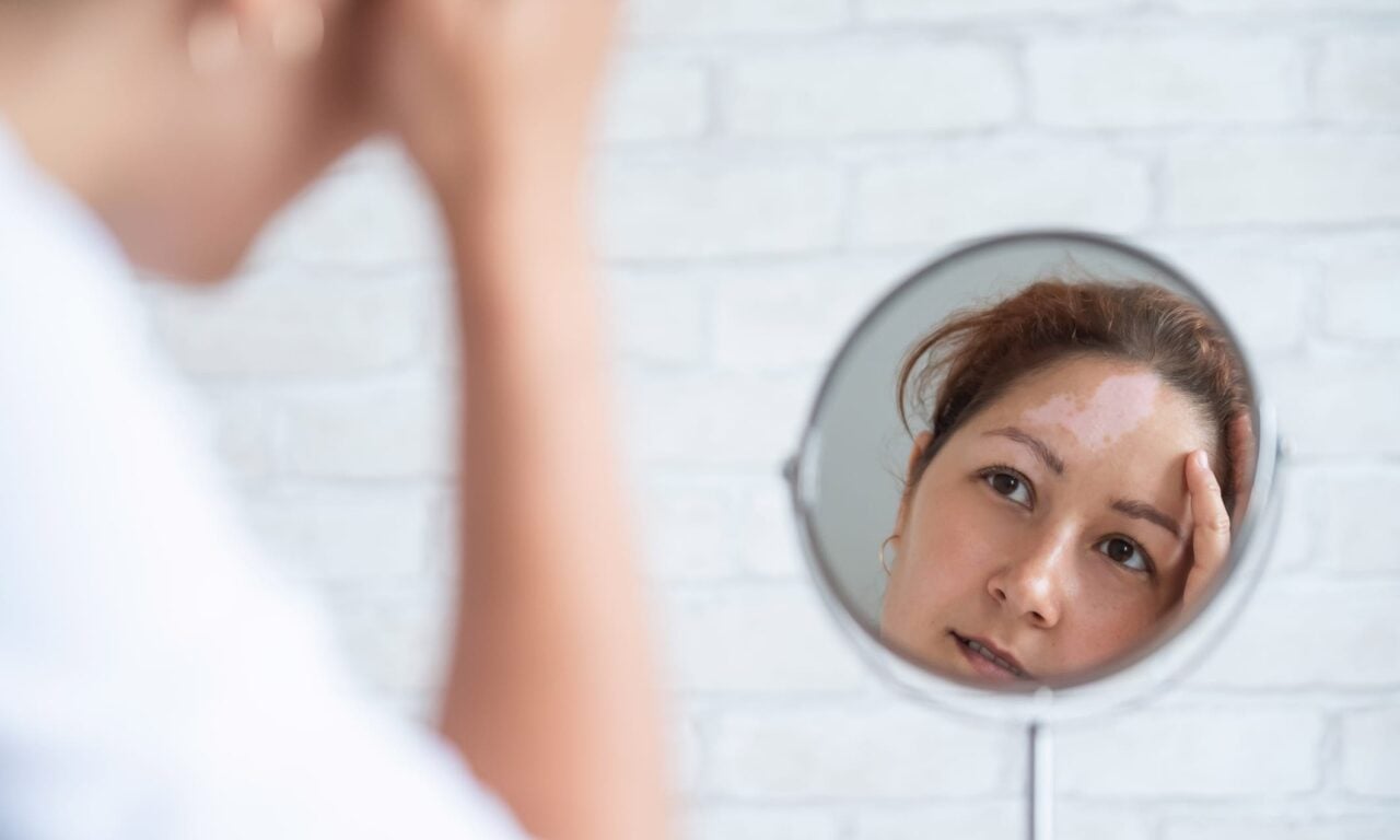 Study Finds Excimer Laser, JAK Inhibitor Combo Effective for Vitiligo