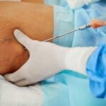 AI Model Predicts Blood Loss in High-Volume Liposuction, Study Finds