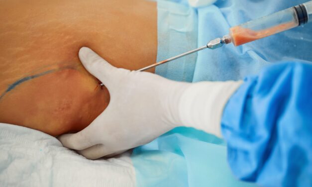 AI Model Predicts Blood Loss in High-Volume Liposuction, Study Finds