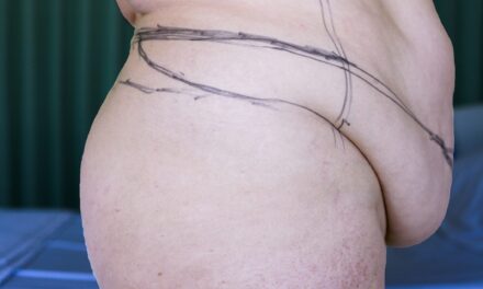 Prior COVID Infection May Raise Blood Clot Risk After Panniculectomy