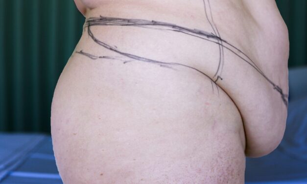 Prior COVID Infection May Raise Blood Clot Risk After Panniculectomy