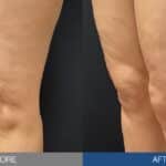 Ultrasound Gains Clinical Ground in Cellulite Treatment