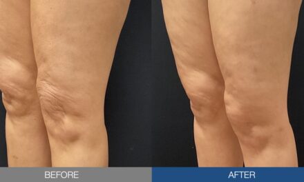 Ultrasound Gains Clinical Ground in Cellulite Treatment