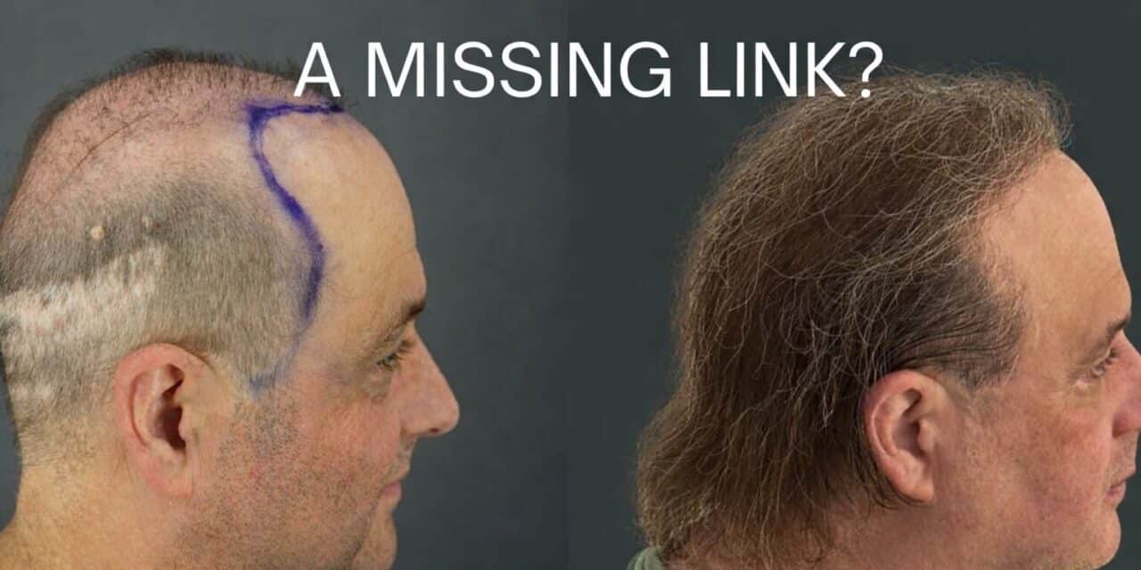 Hidden Scalp Inflammation May Explain Why Common Hair Loss Treatments Stop Working