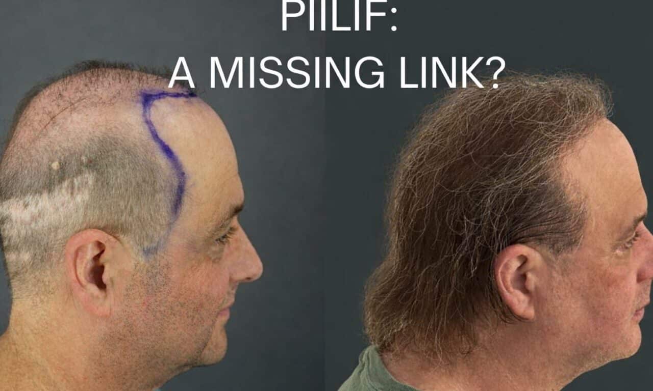 Hidden Scalp Inflammation May Explain Why Common Hair Loss Treatments Stop Working