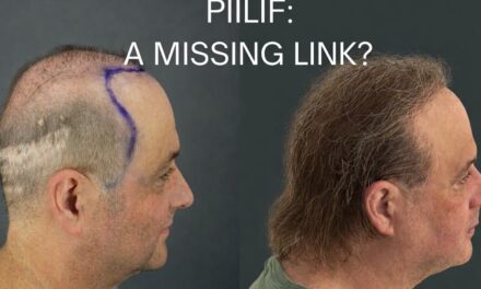 Hidden Scalp Inflammation May Explain Why Common Hair Loss Treatments Stop Working