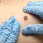 Study Finds Noninvasive Imaging Improves Accuracy in Evaluating Suspicious Moles