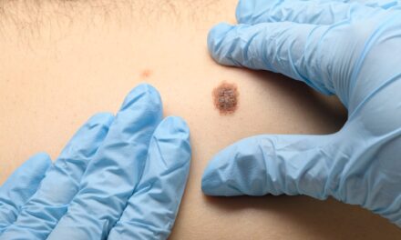 Study Finds Noninvasive Imaging Improves Accuracy in Evaluating Suspicious Moles