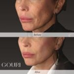 Dexlevo Showcases PCL Collagen Stimulator Data at IMCAS 2026