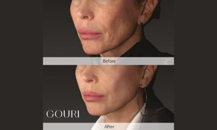 Dexlevo Showcases PCL Collagen Stimulator Data at IMCAS 2026