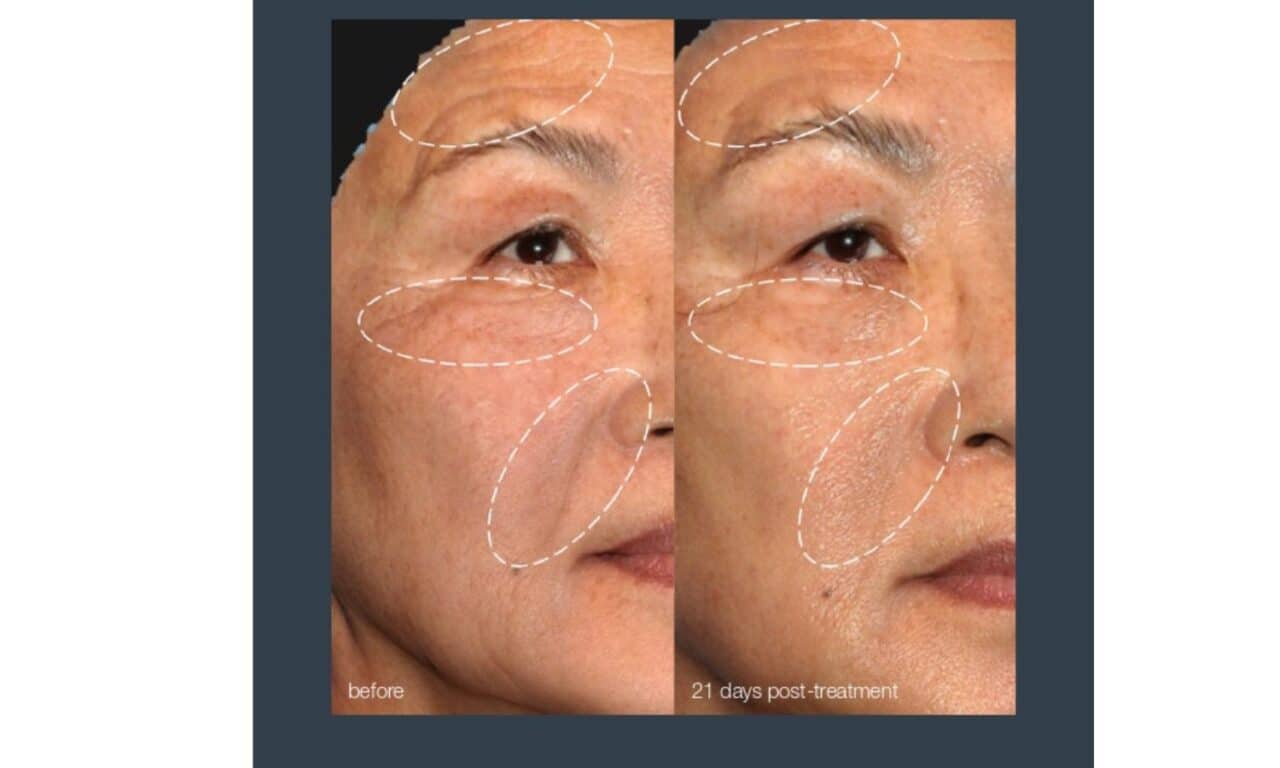 Where Exosomes Fit in Post-Procedure Recovery