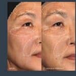 Where Exosomes Fit in Post-Procedure Recovery