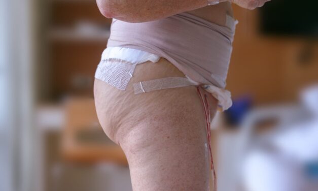 GLP-1 Medications May Affect Complications After Panniculectomy