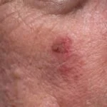Laser Treatment Improves Actinic Keratosis, but ‘Molecular Scar’ May Persist, Study Finds