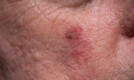 Laser Treatment Improves Actinic Keratosis, but ‘Molecular Scar’ May Persist, Study Finds