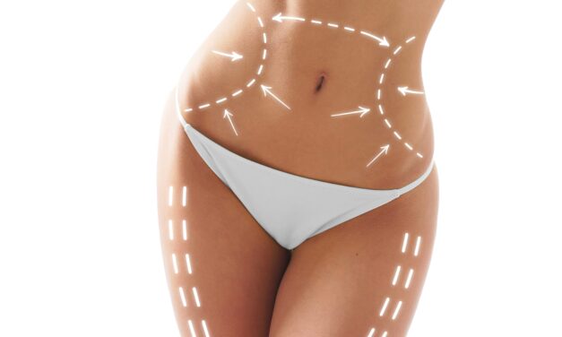 Helium Plasma RF-Assisted Liposuction Linked to Higher Patient Satisfaction, Fewer Revisions