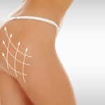Why One Plastic Surgeon Believes Ultrasound-Guided BBLs Are the Future