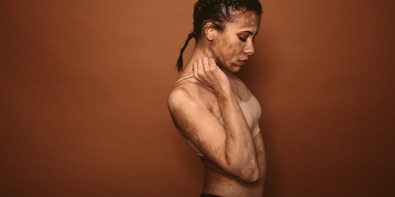 European Regulators Recommend First Potential Systemic Treatment for Vitiligo