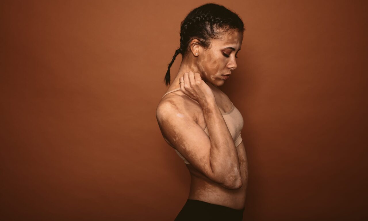 European Regulators Recommend First Potential Systemic Treatment for Vitiligo
