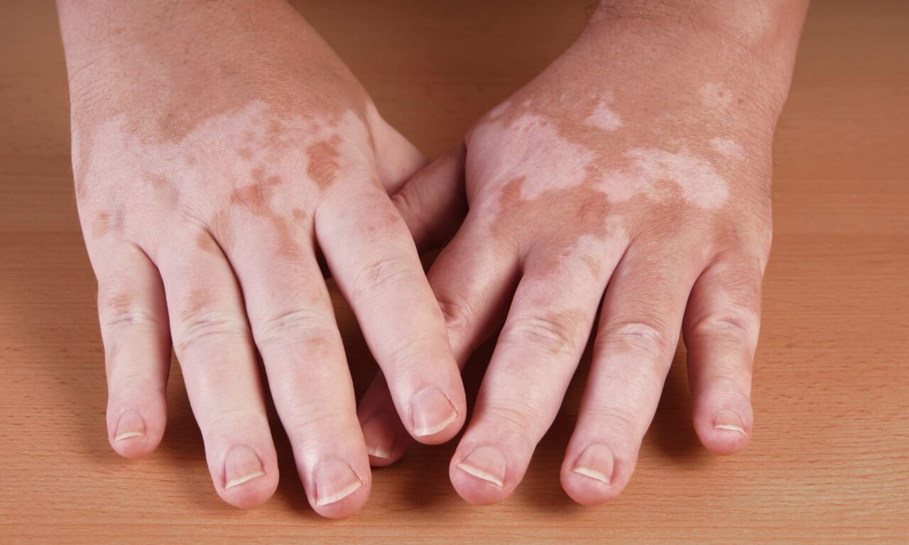 Study Shows Improved Vitiligo Outcomes with Combined Antioxidant and Light Therapy