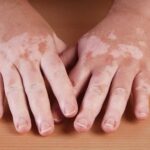 Study Shows Improved Vitiligo Outcomes with Combined Antioxidant and Light Therapy