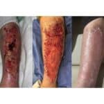 How Spray-On Skin Cells Restore Form and Function After Wound Closure