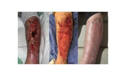 How Spray-On Skin Cells Restore Form and Function After Wound Closure