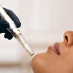 SkinHealth Systems Expands FDA-Cleared Indications for SkinStylus Microneedling Device