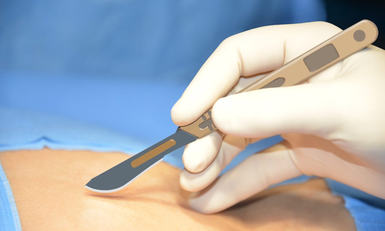 Botulinum Toxin May Help Improve the Appearance of New Scars