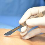 Botulinum Toxin May Help Improve the Appearance of New Scars