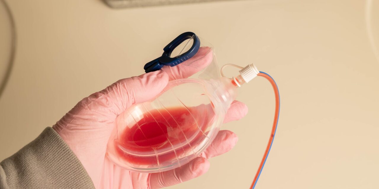 Surgical Drains Do Not Reduce Complications After Breast Reduction, Study Finds