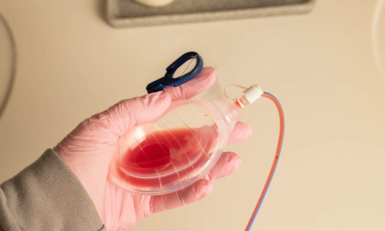 Surgical Drains Do Not Reduce Complications After Breast Reduction, Study Finds