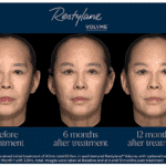 Restylane Volyme Shows Sustained Improvement in Temple Hollowing in China Study