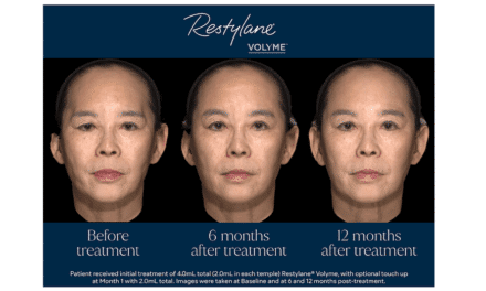 Restylane Volyme Shows Sustained Improvement in Temple Hollowing in China Study