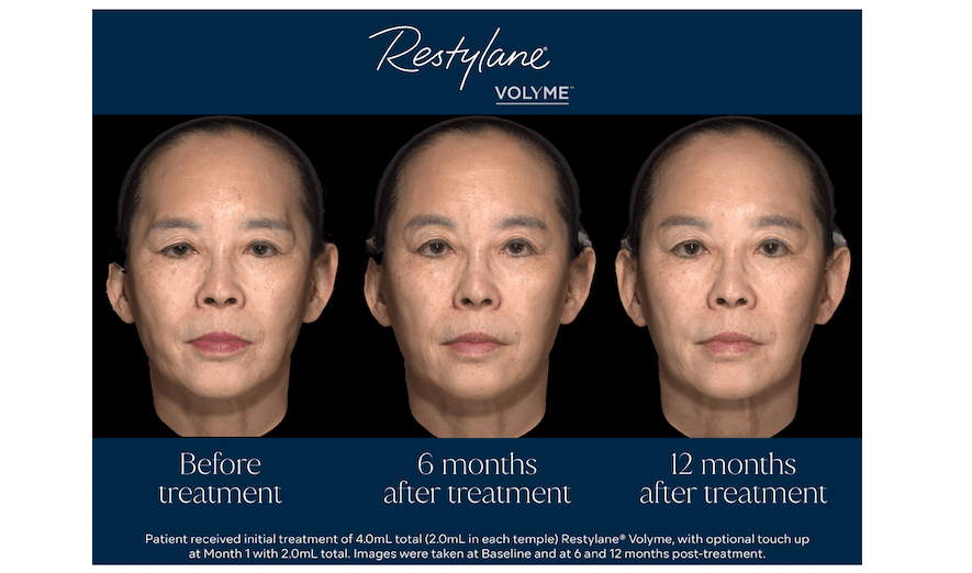 Restylane Volyme Shows Sustained Improvement in Temple Hollowing in China Study