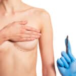 How Long-Term Breast Augmentation Shapes the Explantation Approach