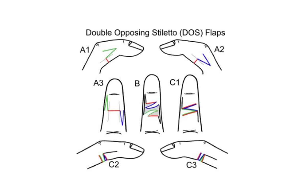 Reconstructing Pediatric Finger Contractures With the DOS Flap