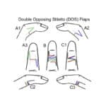 Reconstructing Pediatric Finger Contractures With the DOS Flap